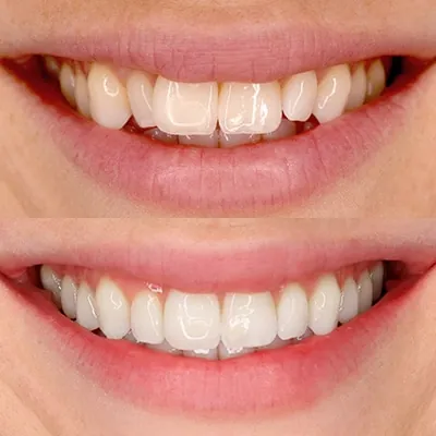 Smile Results