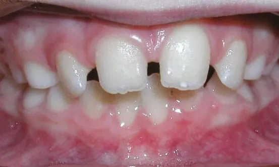 Tooth Spacing