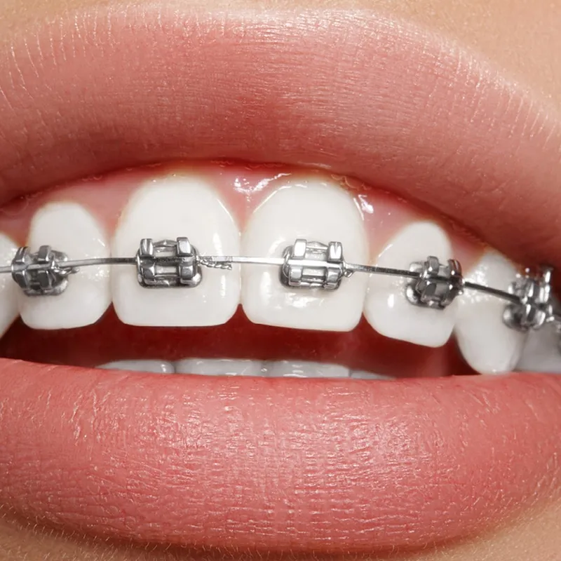 Metal Braces