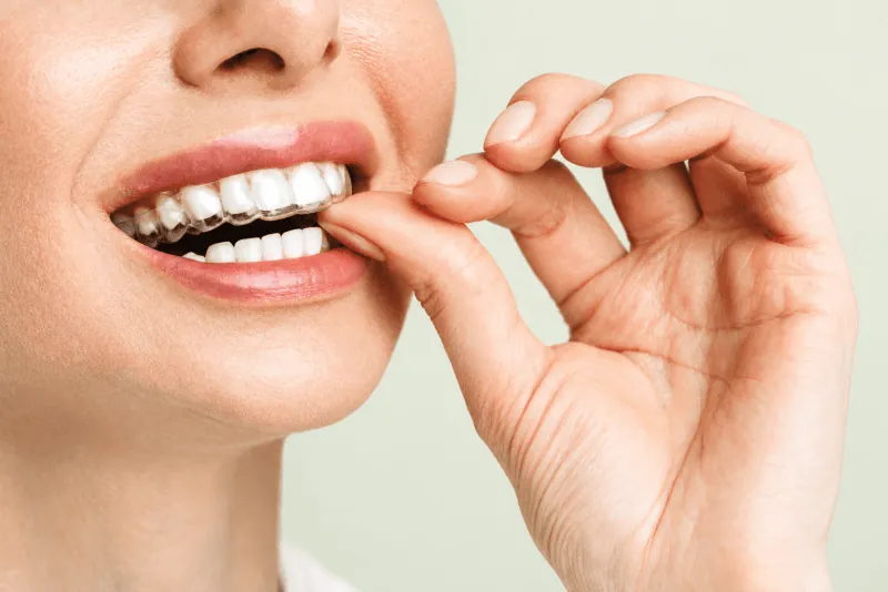 Aligner Insert