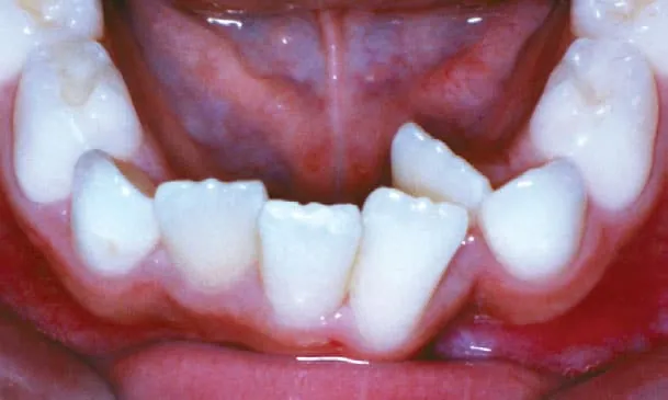 Tooth Crowding