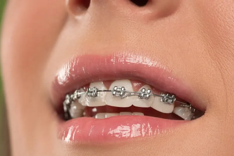 Braces Closeup