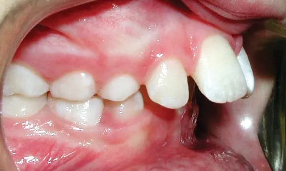 Tooth Protrusion