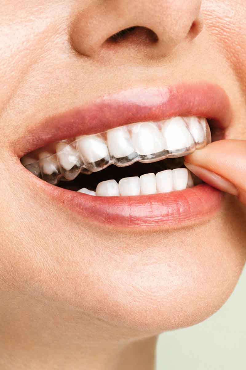 Invisalign Aligner