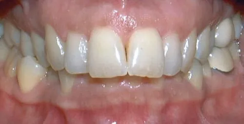 Deep Bite