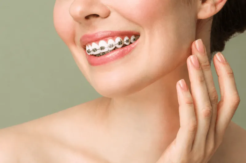 Ceramic Braces