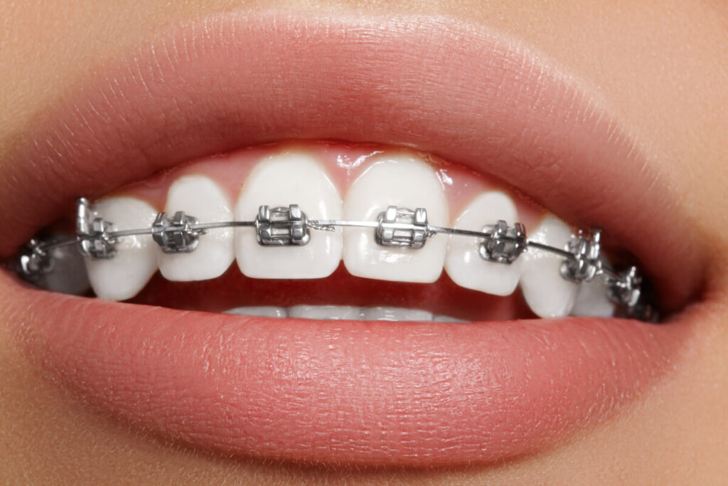 Close-up of a smile with metal brackets and an archwire on the upper teeth